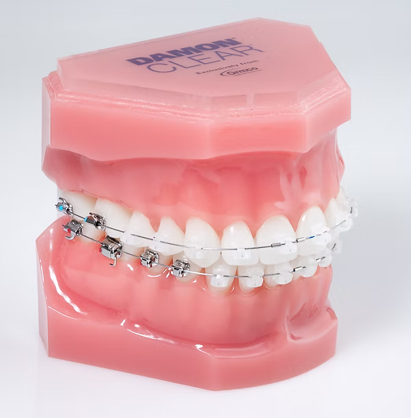 Behandlung mit Keramikbrackets