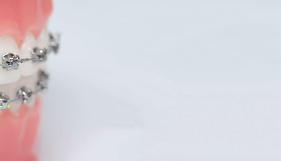 Festsitzende Zahnspange-titel